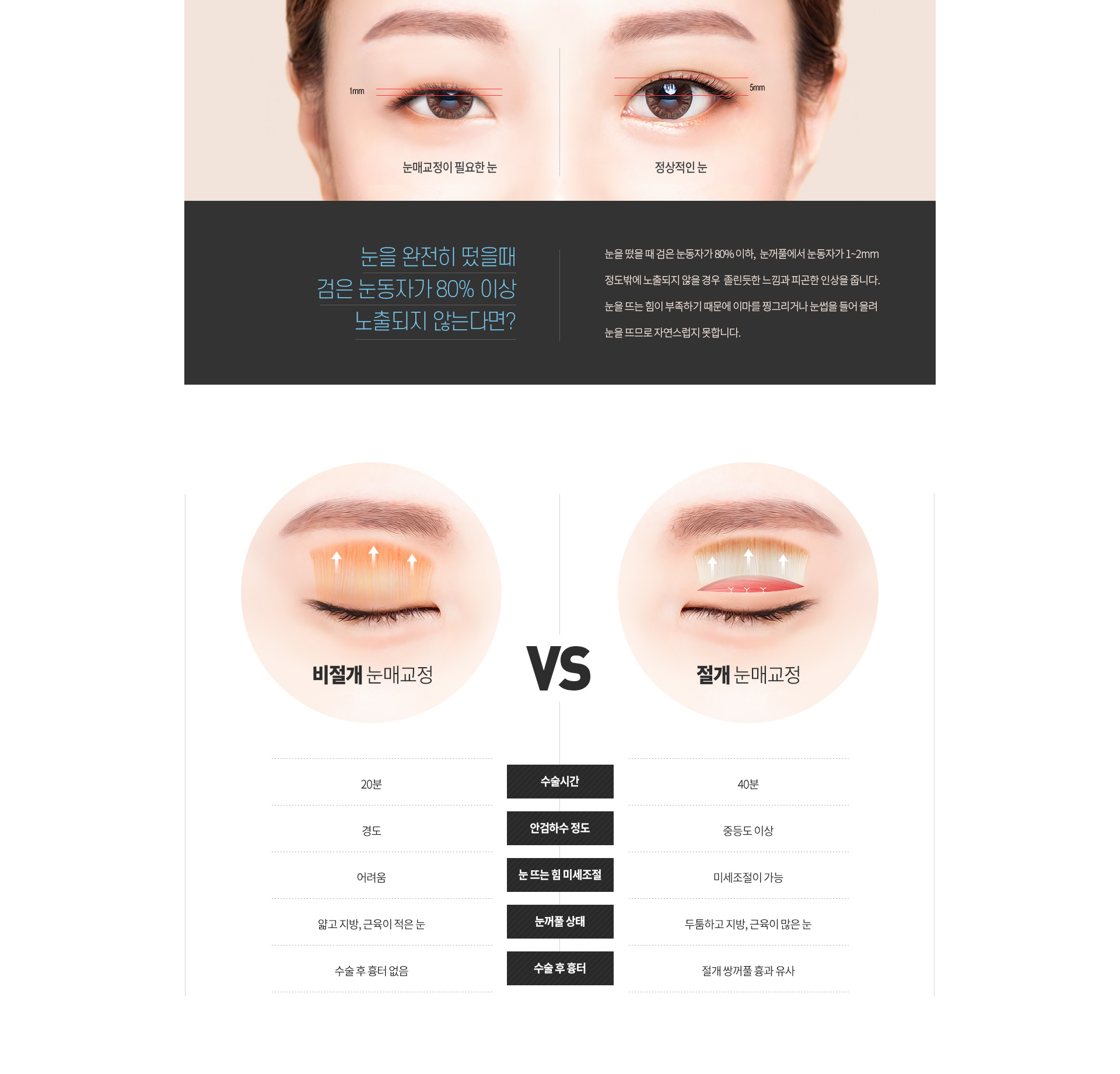 연세결성형외과 눈성형 절개 비절개 눈매교정 비교